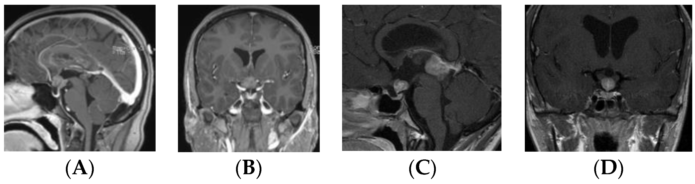 Frontiers  Multiple ectopic recurrent germ cell tumors after