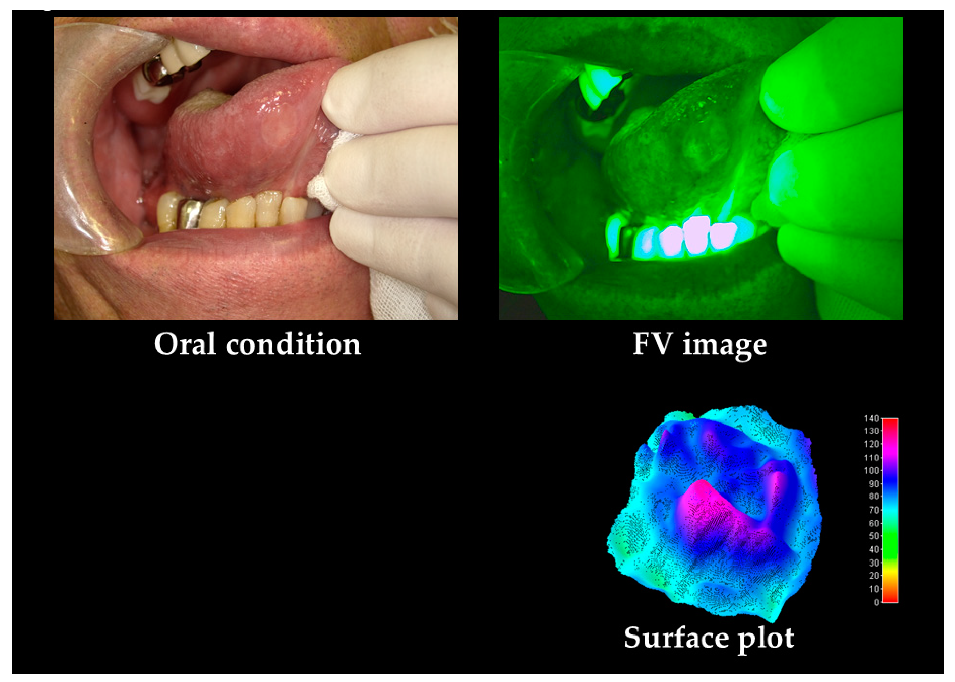 Cancers | Free Full-Text | Non-Invasive Early Detection of Oral Cancers  Using Fluorescence Visualization with Optical Instruments | HTML