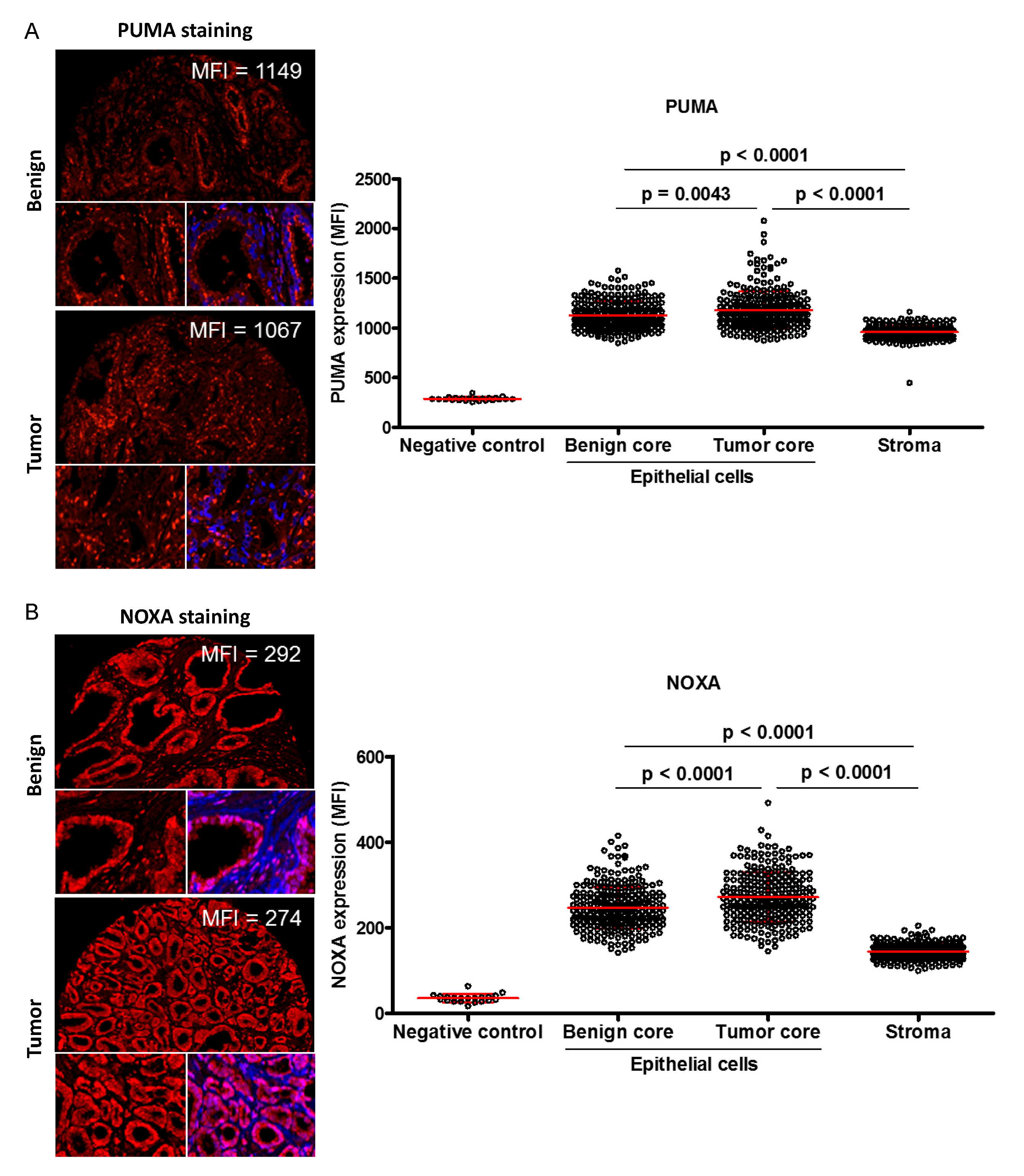 Cancers | Free Full-Text | PUMA and NOXA Expression in Tumor-Associated  Benign Prostatic Epithelial Cells Are Predictive of Prostate Cancer  Biochemical Recurrence