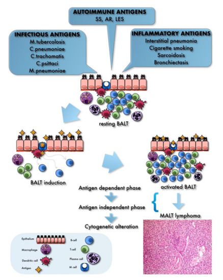 Cancers Free Full Text Primary Pulmonary B Cell Lymphoma A