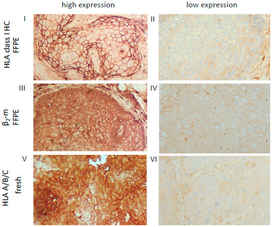 Cancers Free Full Text Tumor Microenvironment HLA Class I and