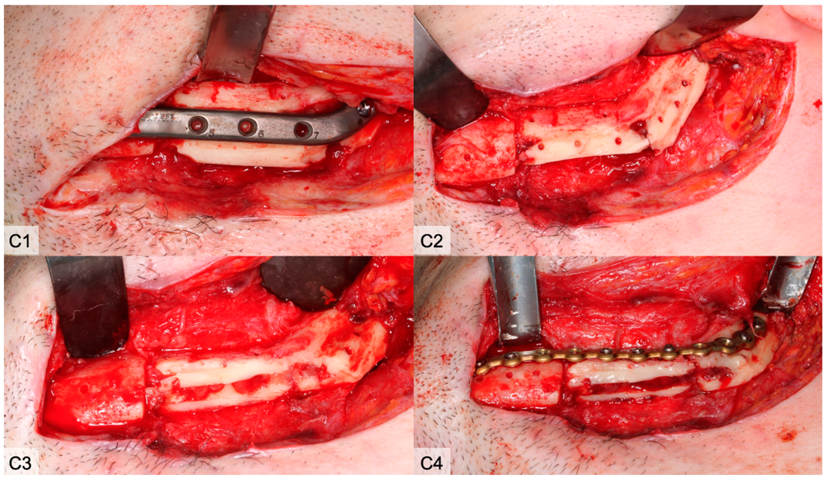 Cancers | Free Full-Text | Partial and Total Flap Failure after 