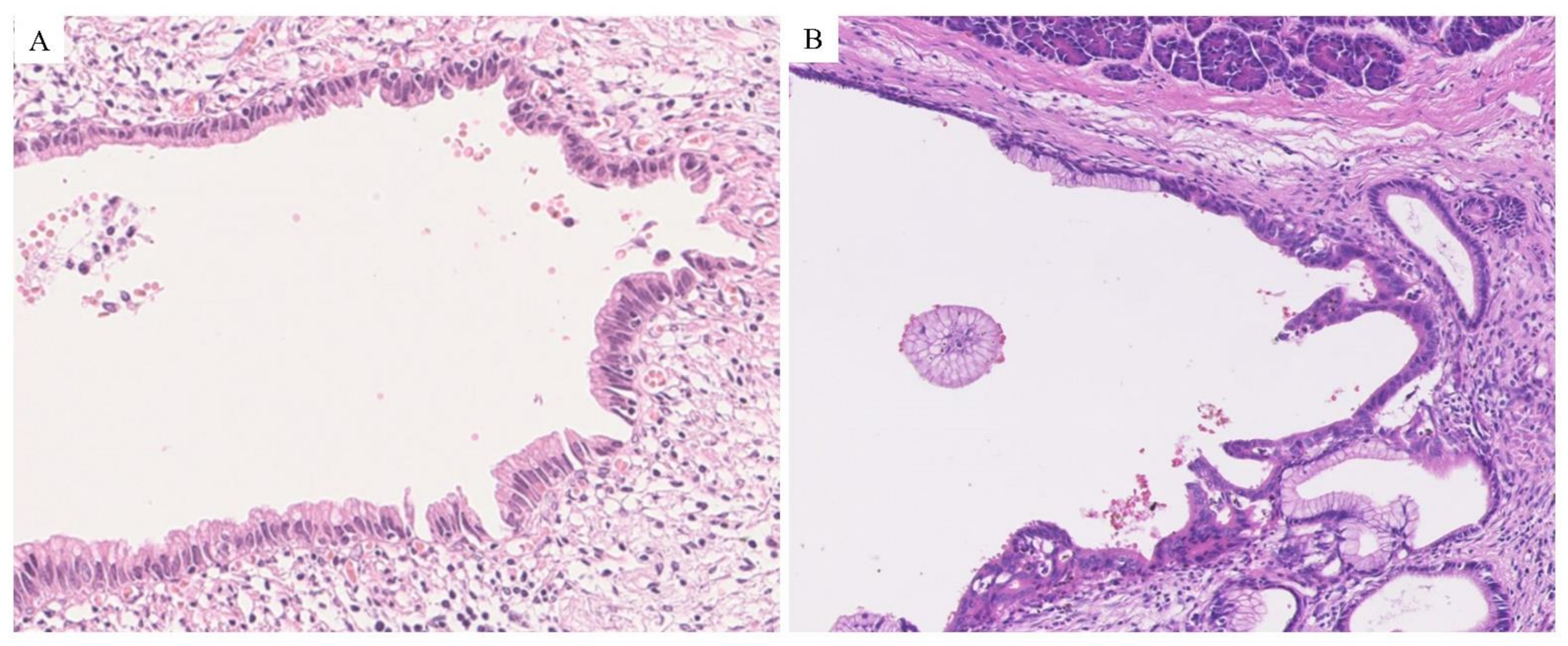 Cancers Free Full Text Pre Operative Imaging And Pathological Diagnosis Of Localized High Grade Pancreatic Intra Epithelial Neoplasia Without Invasive Carcinoma Html