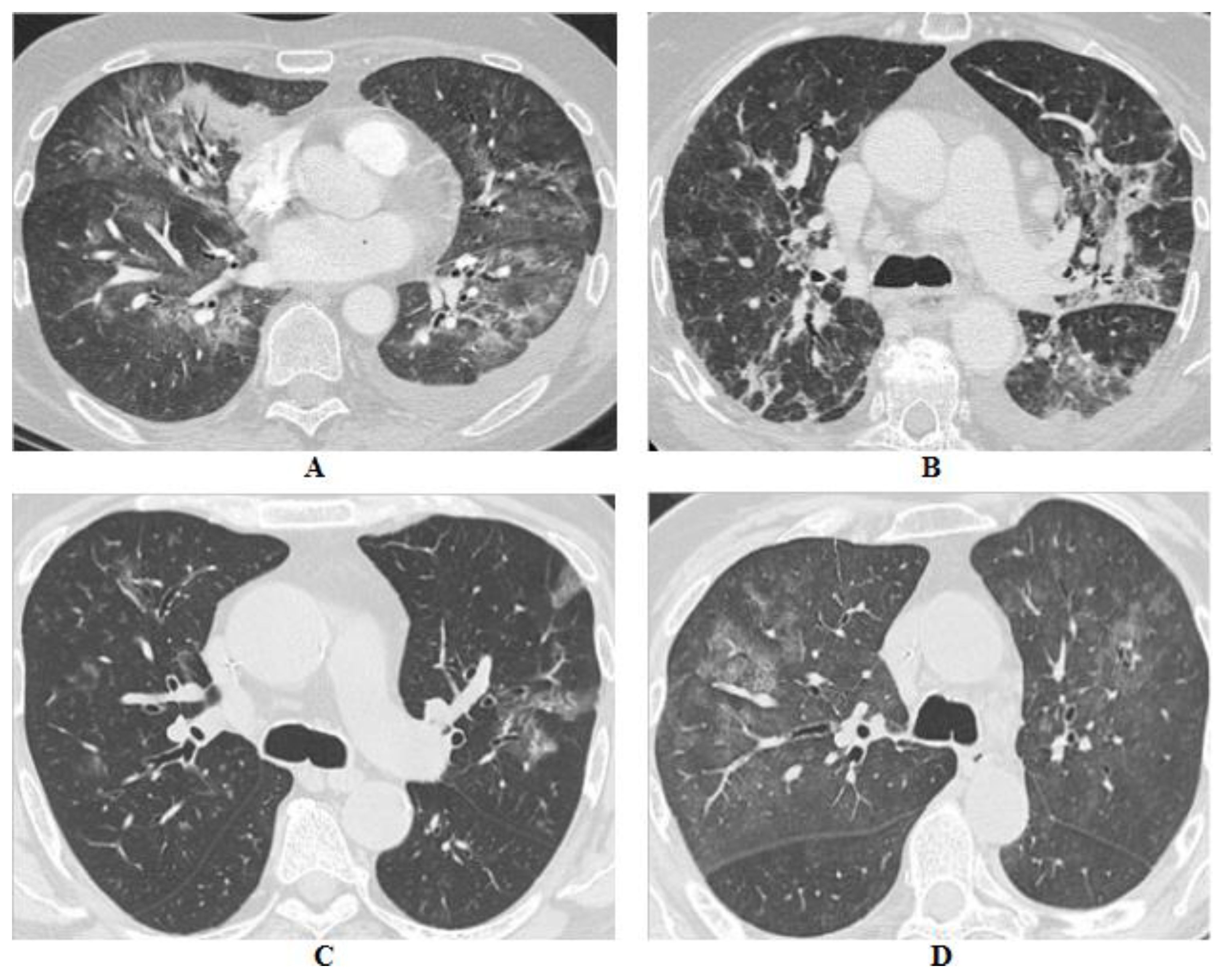 Cancers | Free Full-Text | Drug-Related Pneumonitis in Cancer Treatment ...