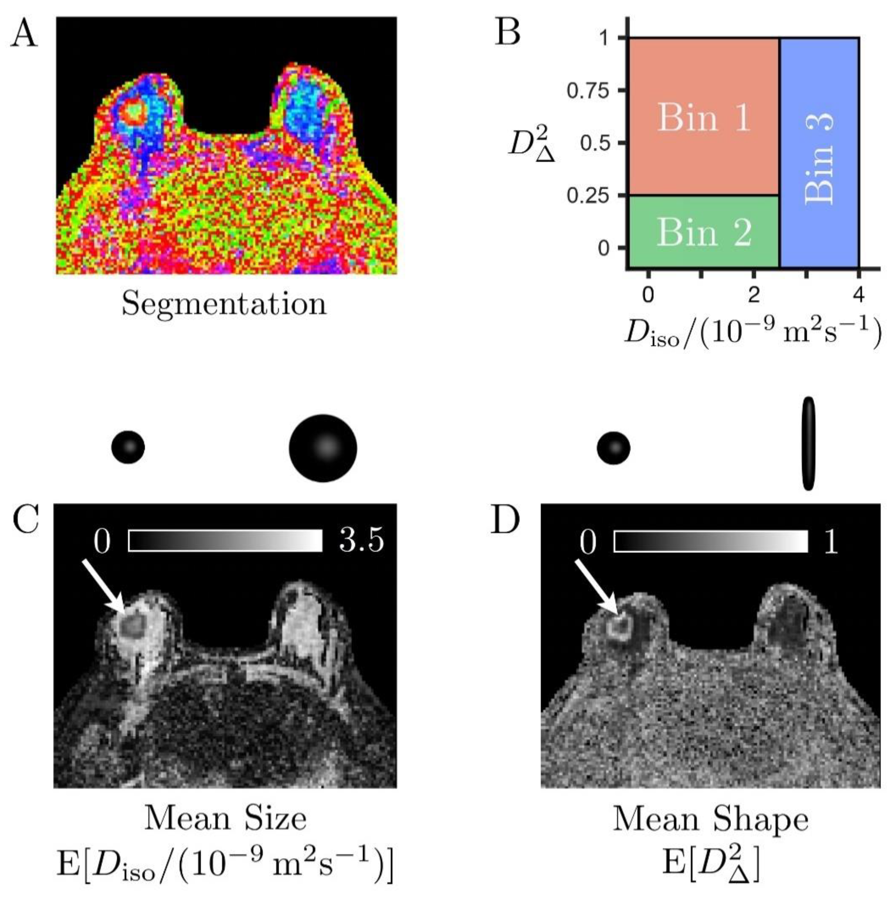 cancers free full text multidimensional diffusion magnetic resonance imaging for characterization of tissue microstructure in breast cancer patients a prospective pilot study html