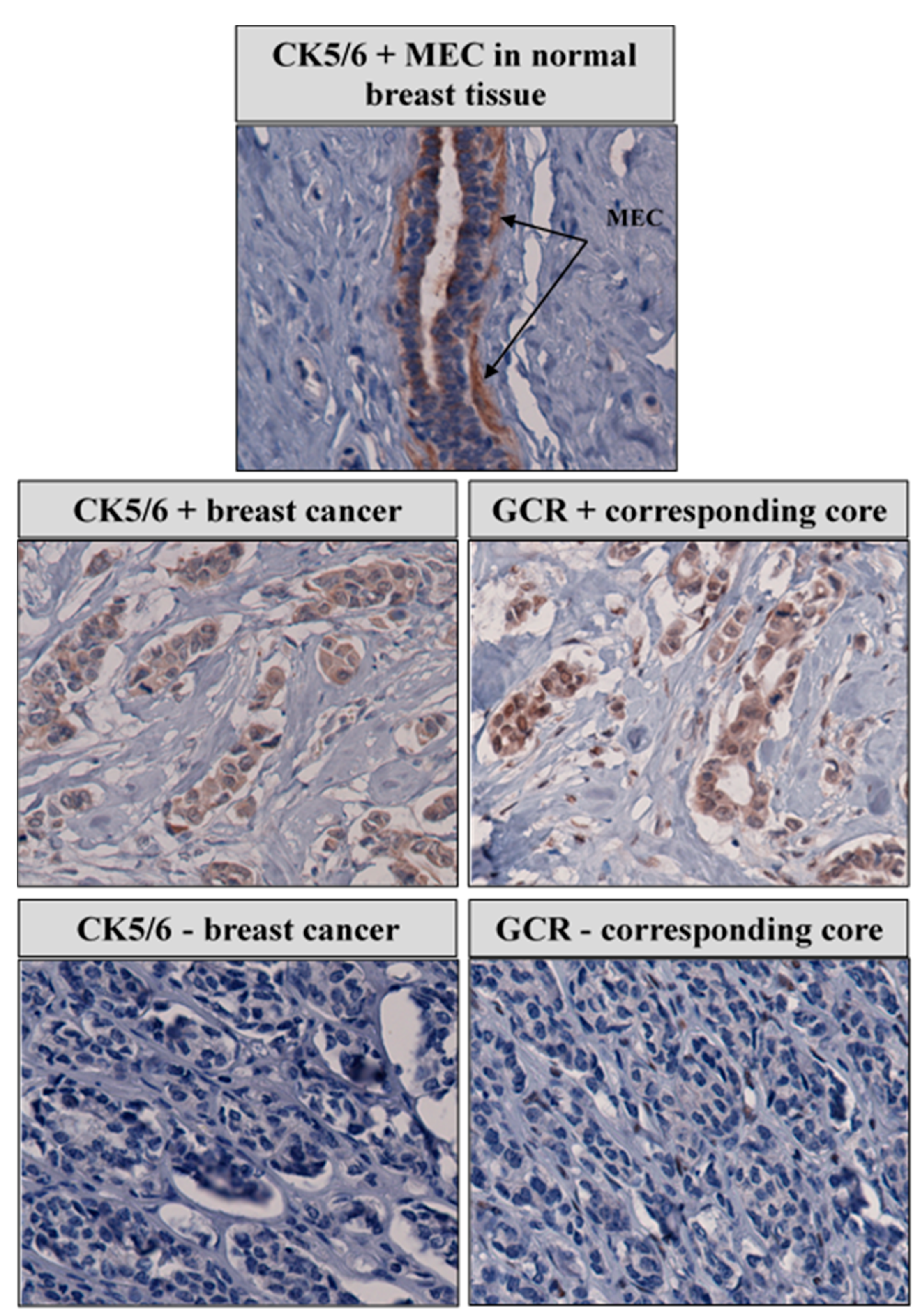 Cancers Free Full Text Genetic Variation And Immunohistochemical Localization Of The Glucocorticoid Receptor In Breast Cancer Cases From The Breast Cancer Care In Chicago Cohort Html