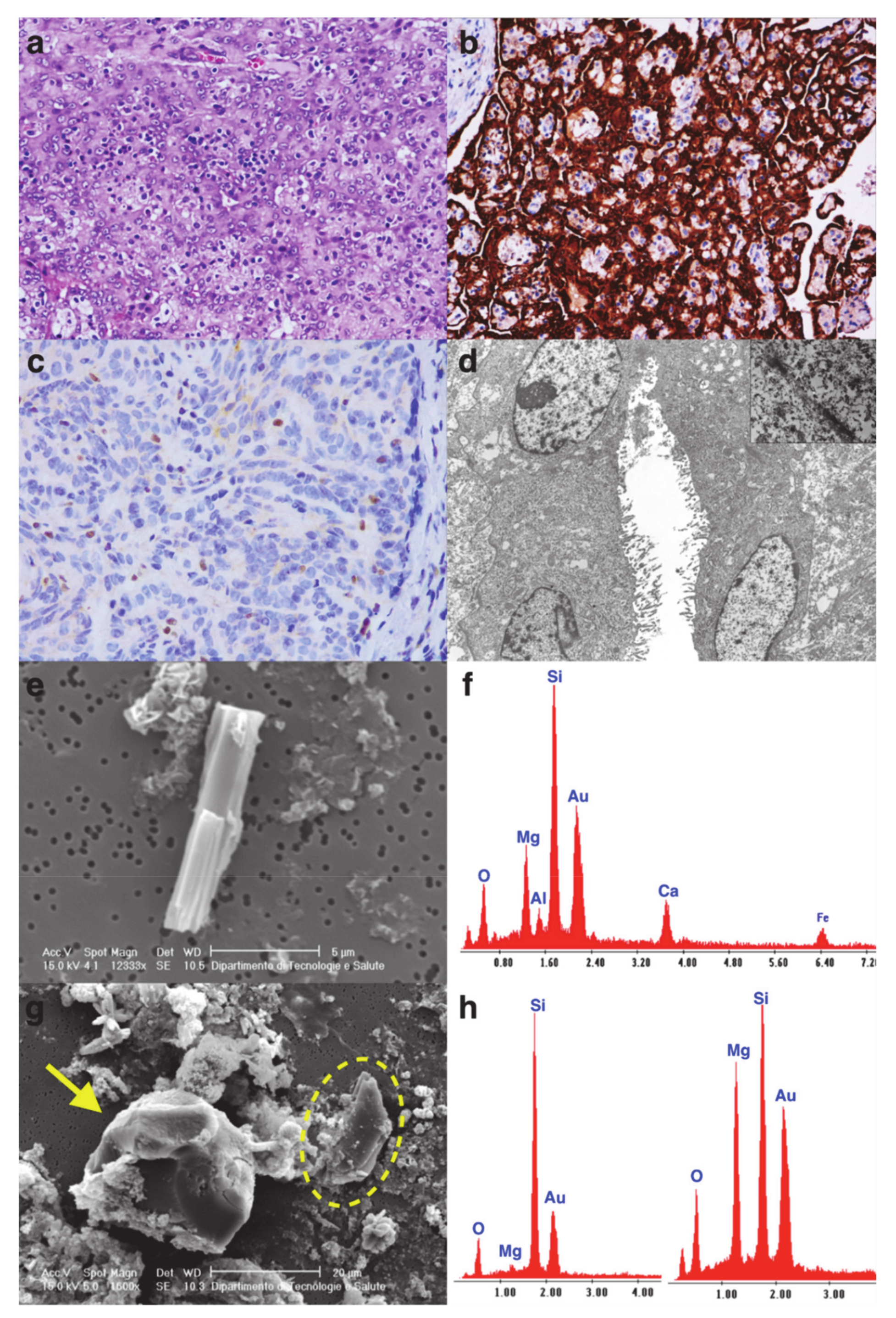 Cancers | Free Full-Text | Primary Ovarian Mesothelioma: A Case Series with  Electron Microscopy Examination and Review of the Literature