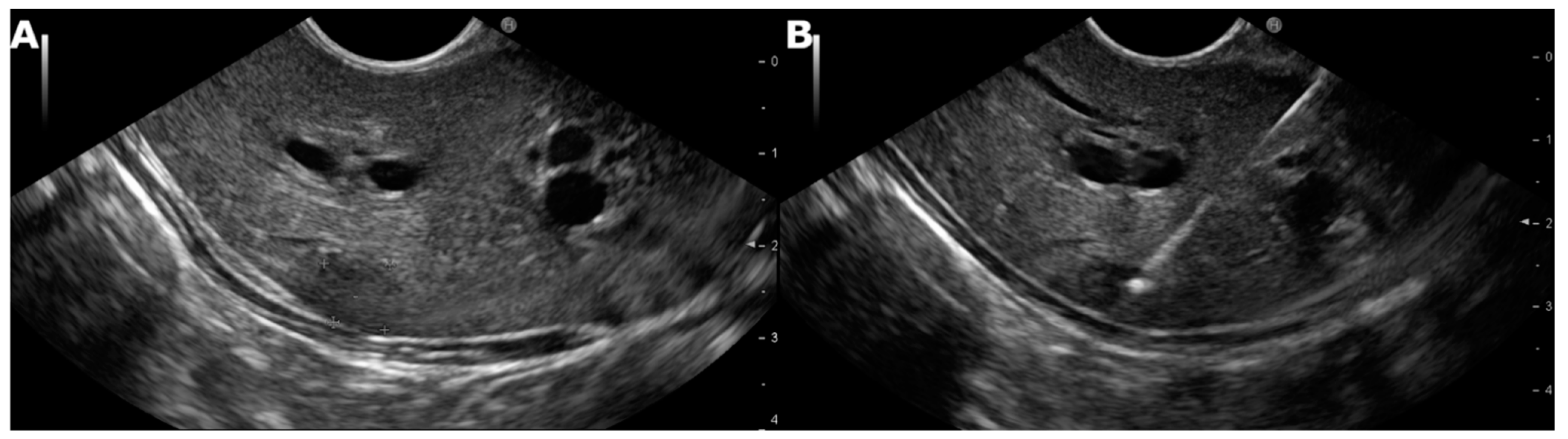 Cancers Free Full Text Diagnostic Yield Of Endoscopic Ultrasound Guided Liver Biopsy In