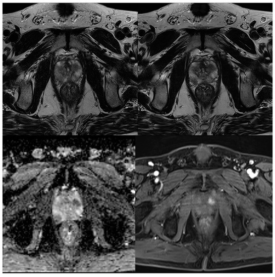 Cancers Free Full Text Accelerated T2 Weighted Tse Imaging Of The