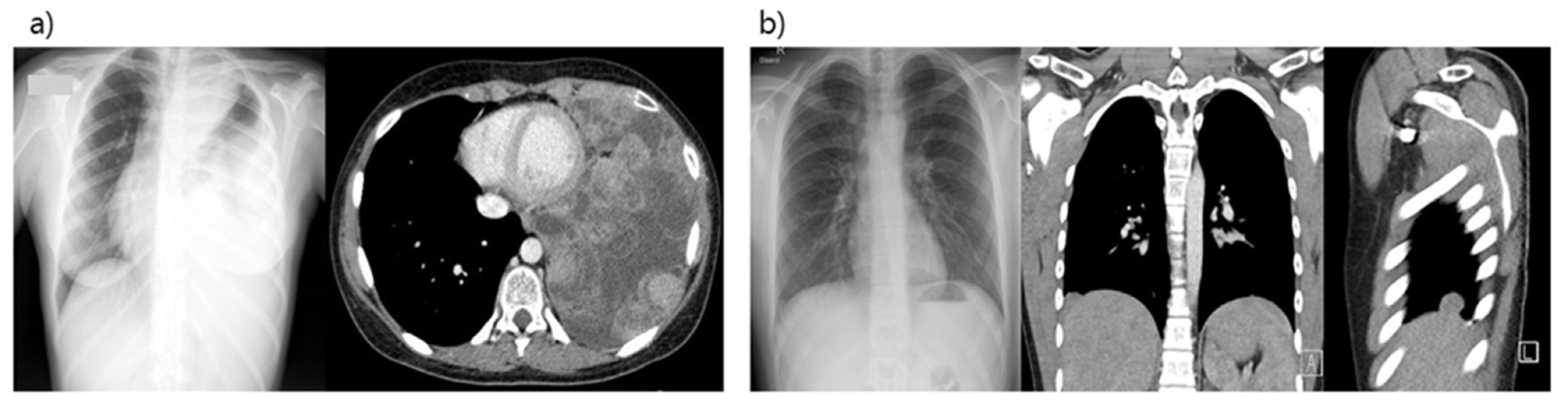 Cancers Free Full-Text Pleuropneumonectomy as Salvage Therapy in Children Suffering from Primary or Metastatic Sarcomas with Pleural Localizations