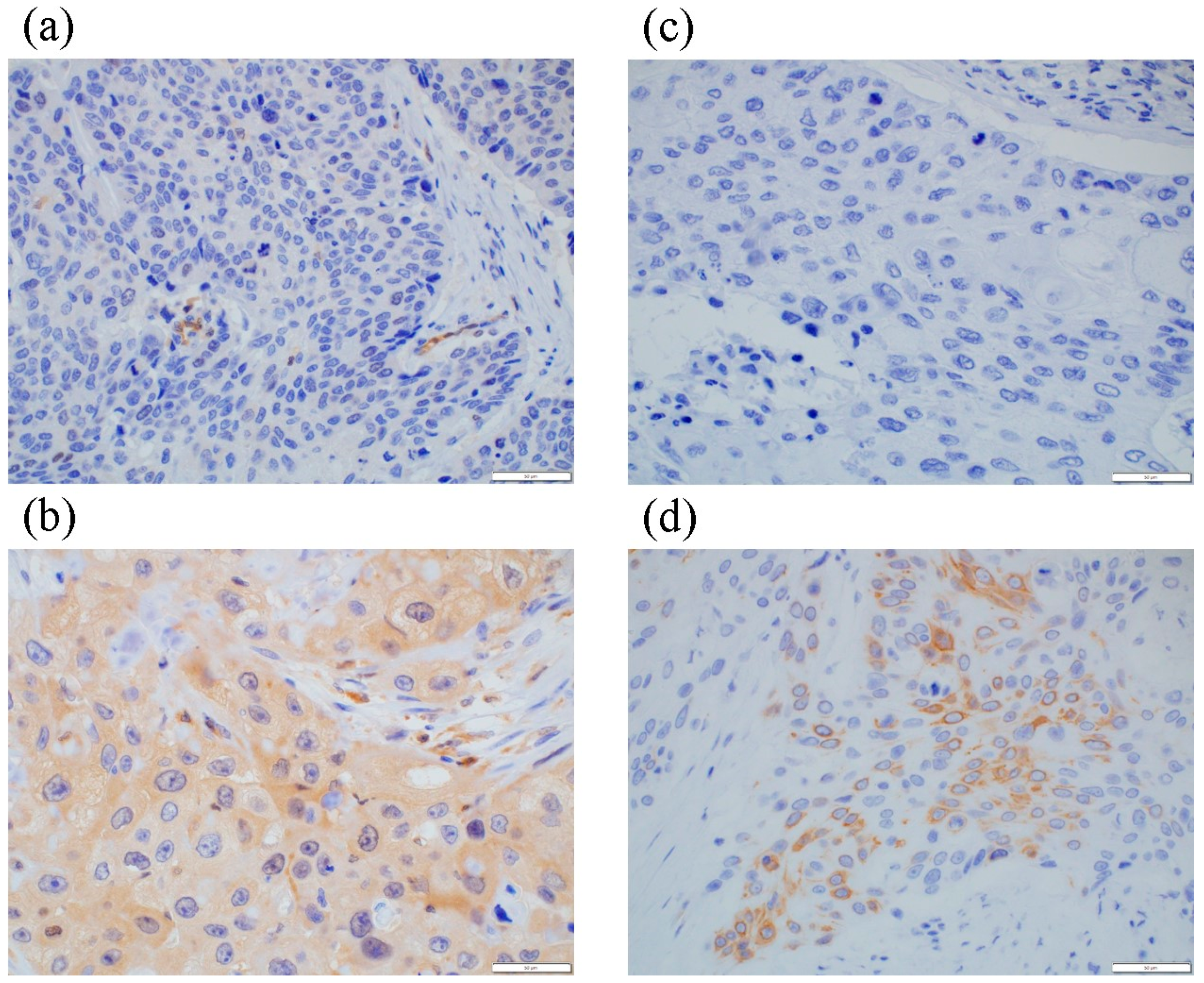 Cancers Free Full Text Necroptosis In Esophageal Squamous Cell Carcinoma An Independent Prognostic Factor And Its Correlation With Tumor Infiltrating Lymphocytes Html