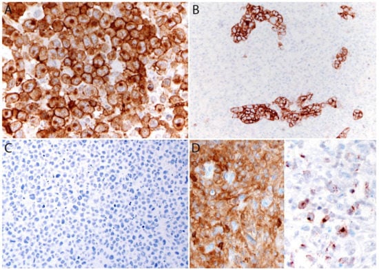 Cancers Free Full Text Alk Negative Anaplastic Large Cell Lymphoma