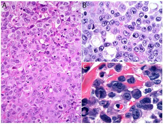 Cancers Free Full Text Alk Negative Anaplastic Large Cell Lymphoma