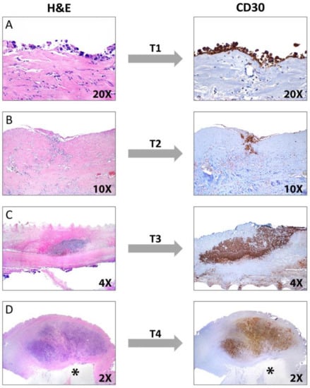 Cancers Free Full Text Alk Negative Anaplastic Large Cell Lymphoma