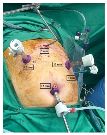 Port placement for gastric mobilization -SAGES Image Library