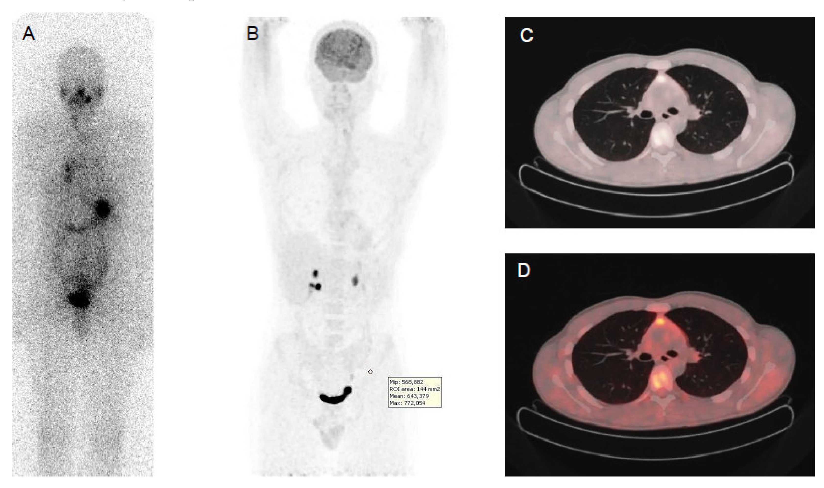 Cancers | Free Full-Text | Advances in Functional Imaging of Differentiated Thyroid  Cancer