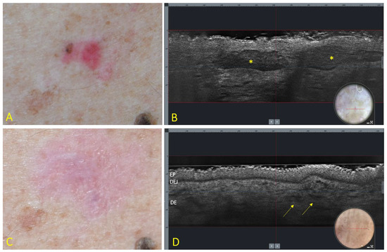 Cancers Free Full Text Line Field Confocal Optical Coherence Tomography May Enhance 