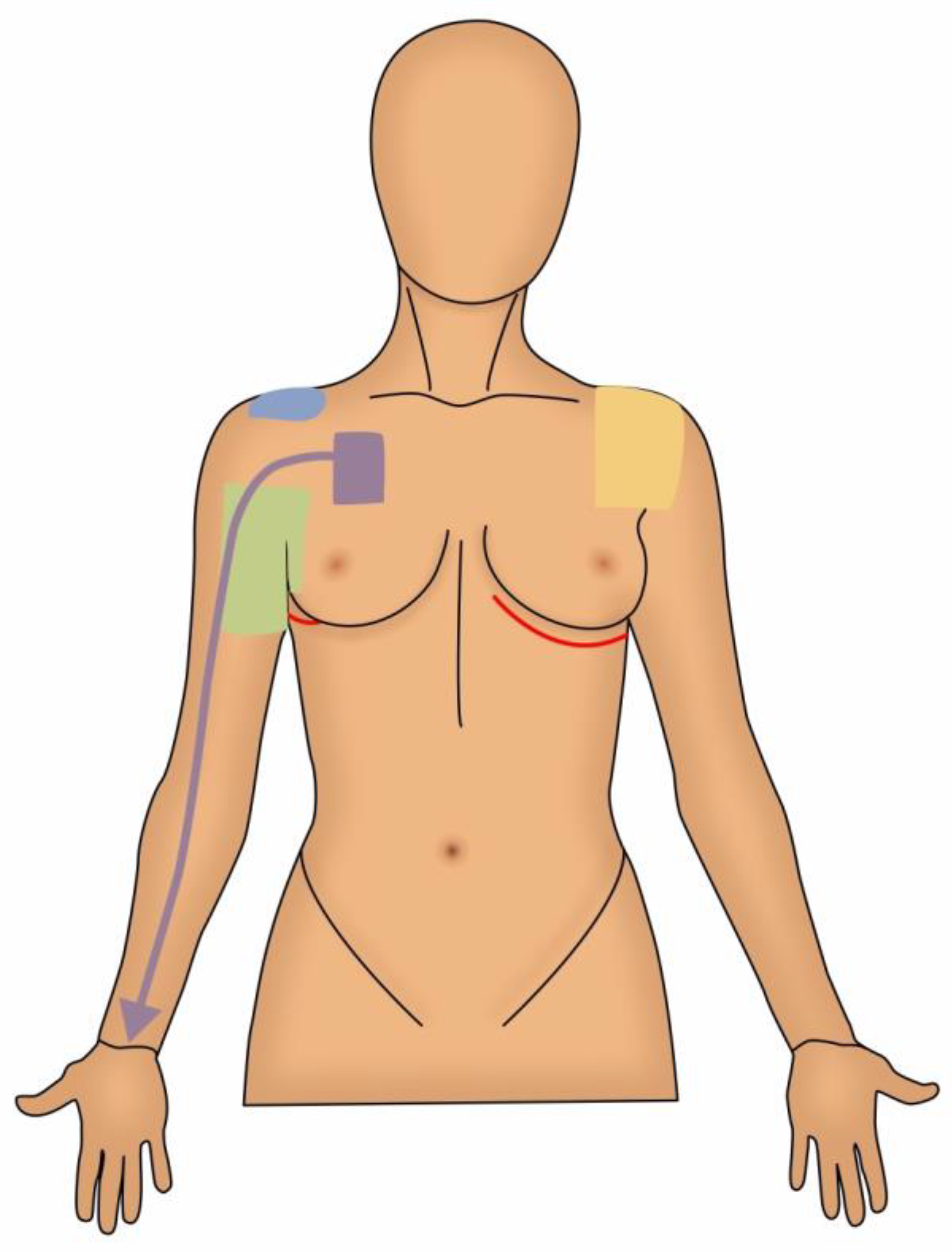 The Original Unilateral Liner (Mastectomy)