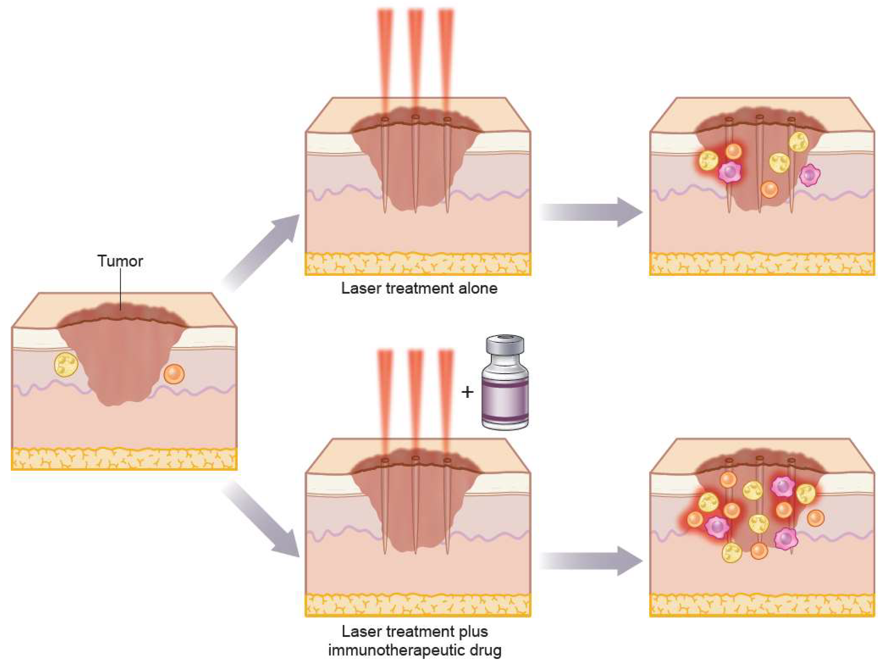 skin cancer laser treatment