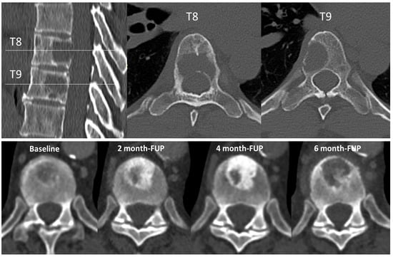 Radiation dose and incidence of new metastasis in the anterior