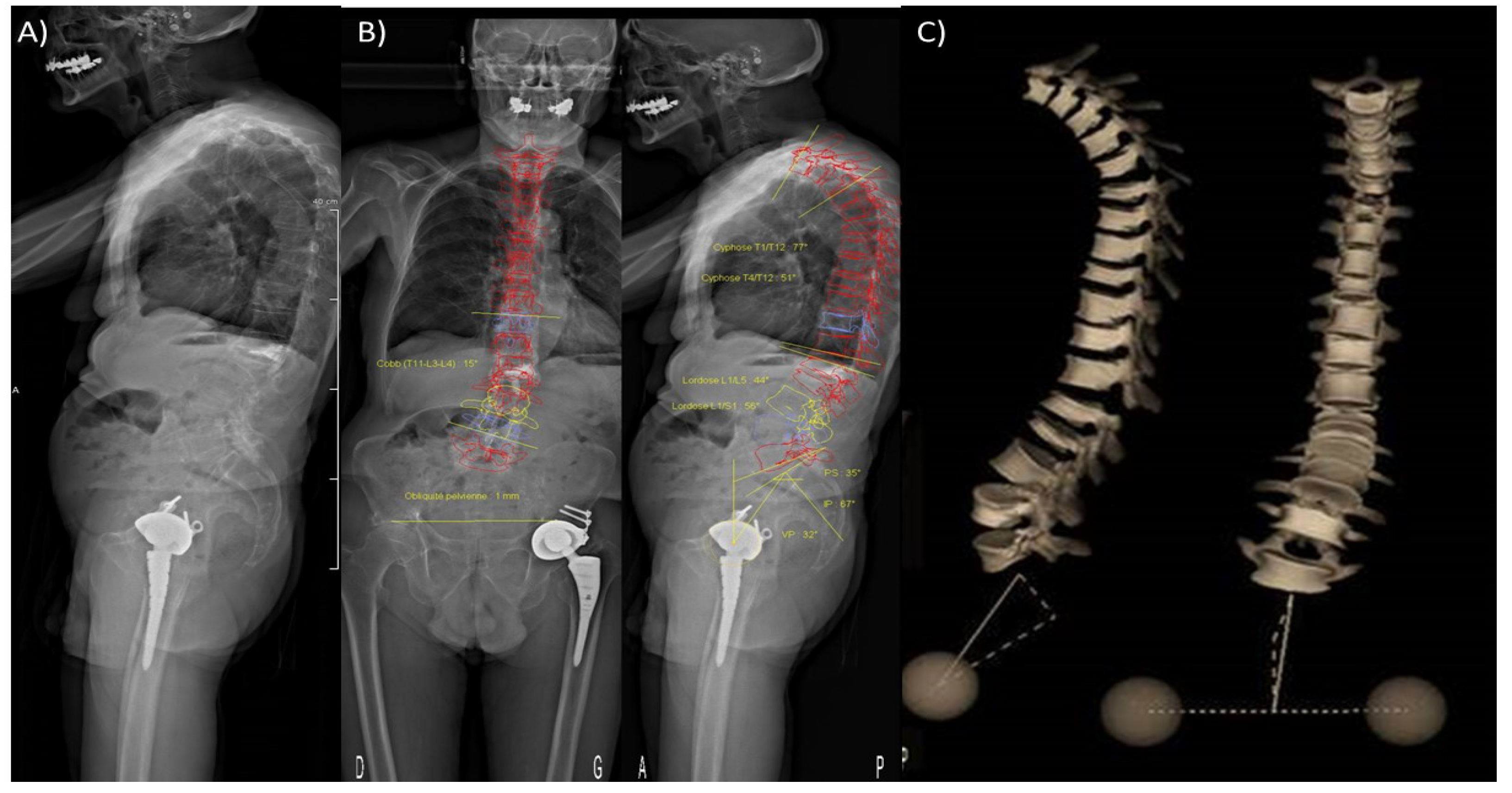 Cancers Free Full Text Fracture Risk Evaluation of Bone