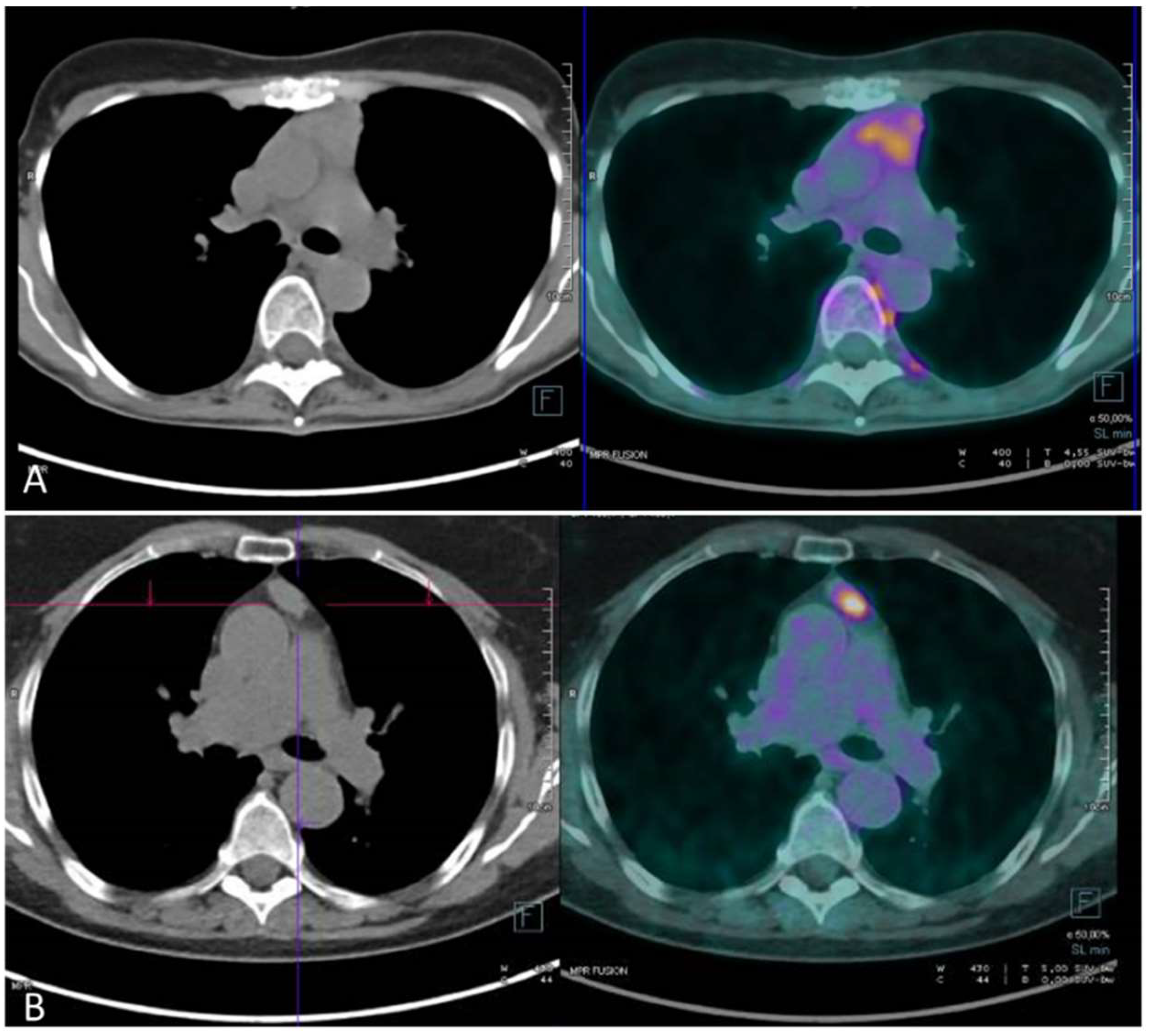 Cancers Free FullText Current Roles of PET/CT in Thymic Epithelial