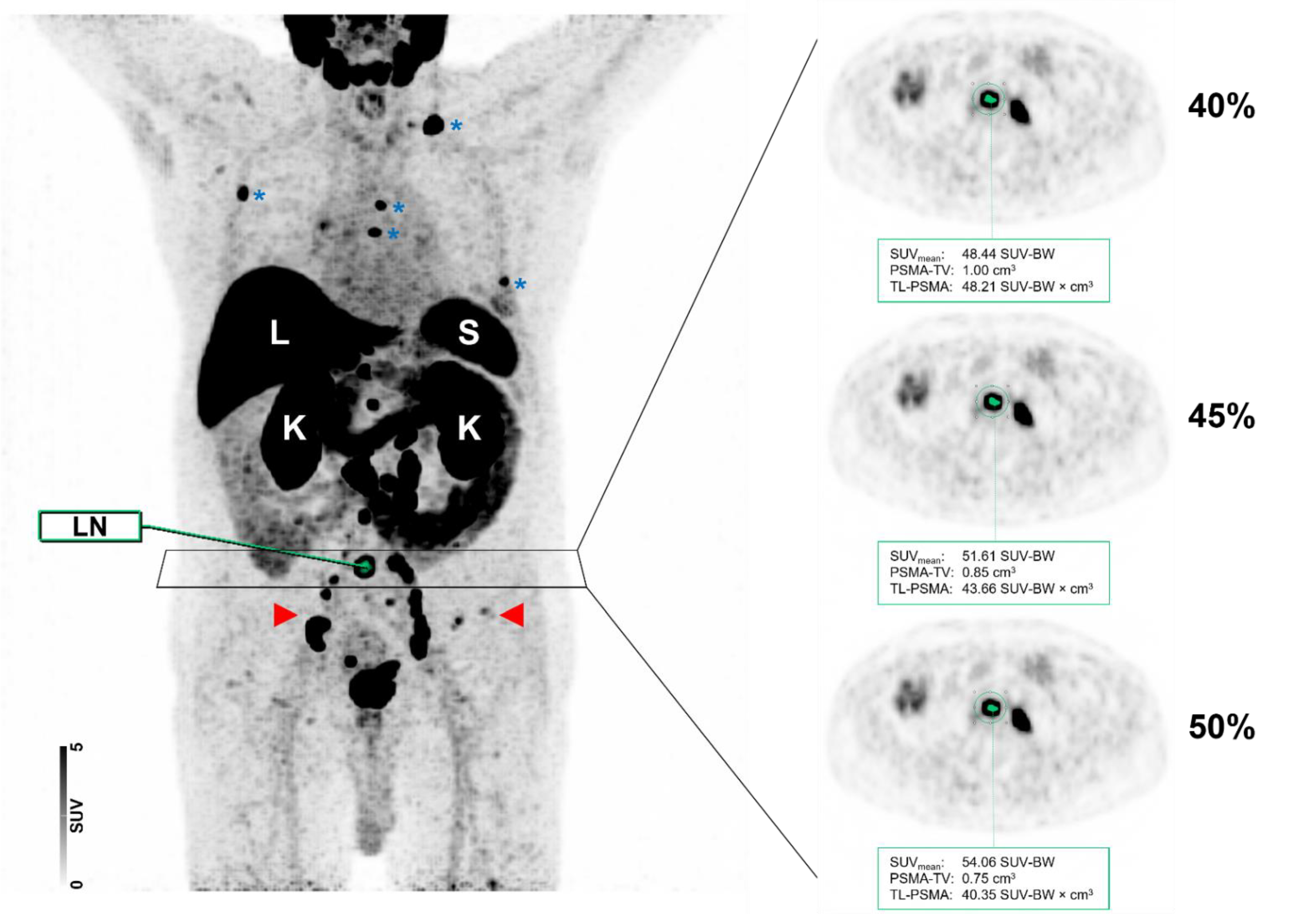 Cancers | Free Full-Text | Changing Threshold-Based Segmentation Has No  Relevant Impact on Semi-Quantification in the Context of Structured  Reporting for PSMA-PET/CT | HTML