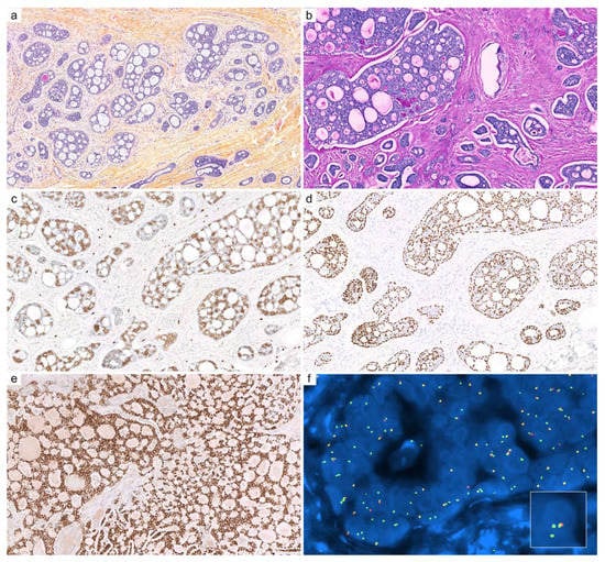 Cancers | Free Full-Text | Recent Advances on Immunohistochemistry and  Molecular Biology for the Diagnosis of Adnexal Sweat Gland Tumors
