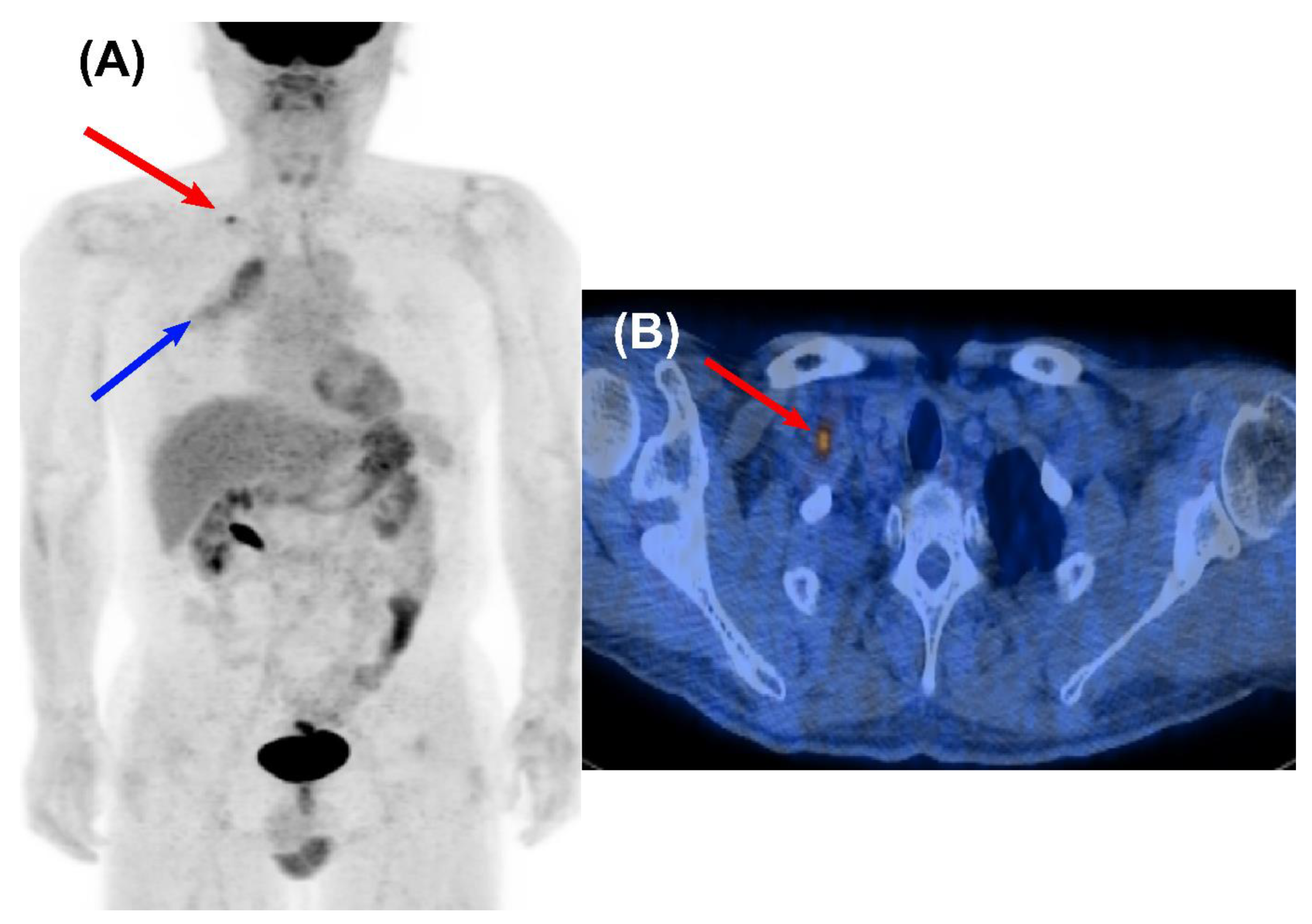 Cancers | Free Full-Text | Clinical Value of Surveillance  18F-fluorodeoxyglucose PET/CT for Detecting Unsuspected Recurrence or  Second Primary Cancer in Non-Small Cell Lung Cancer after Curative Therapy  | HTML