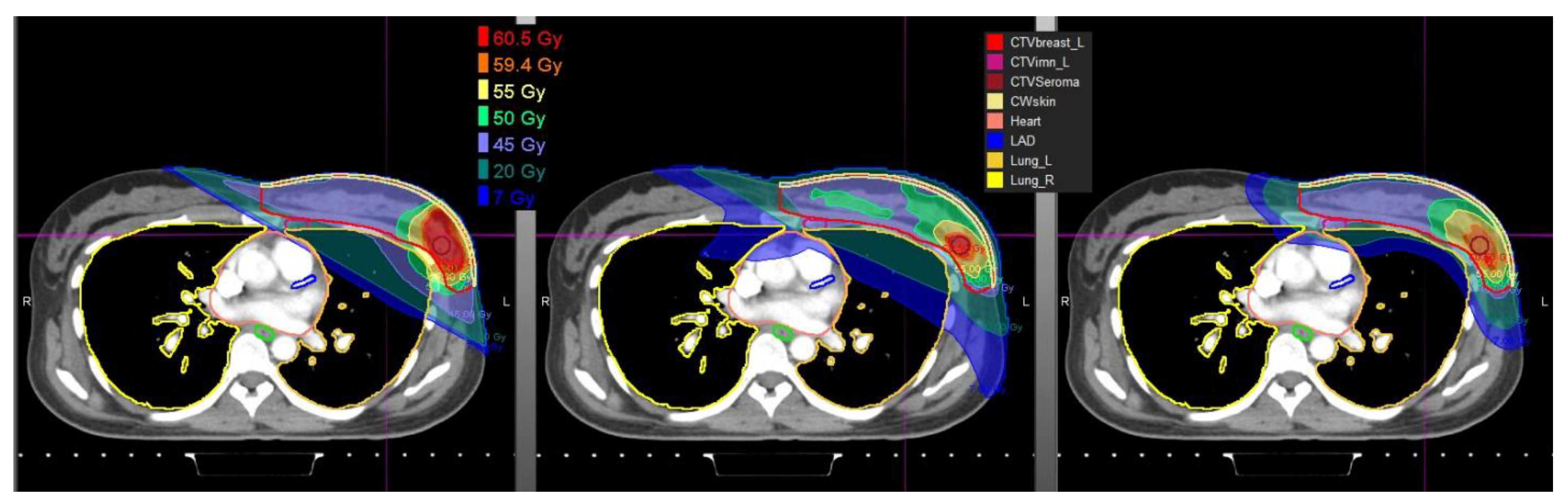 Proton Therapy for Breast Cancer