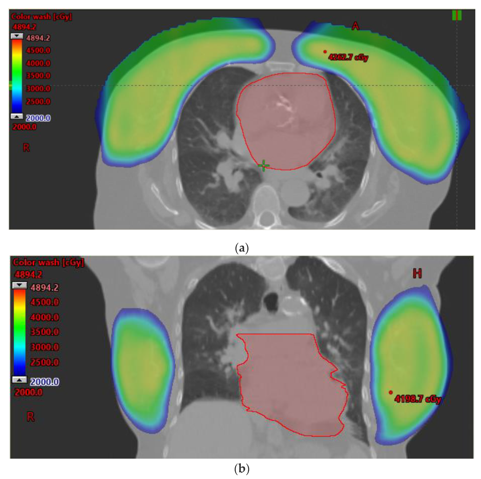 Evidencing the Future of Breast Radiotherapy: Insights from Dr. Rahimi