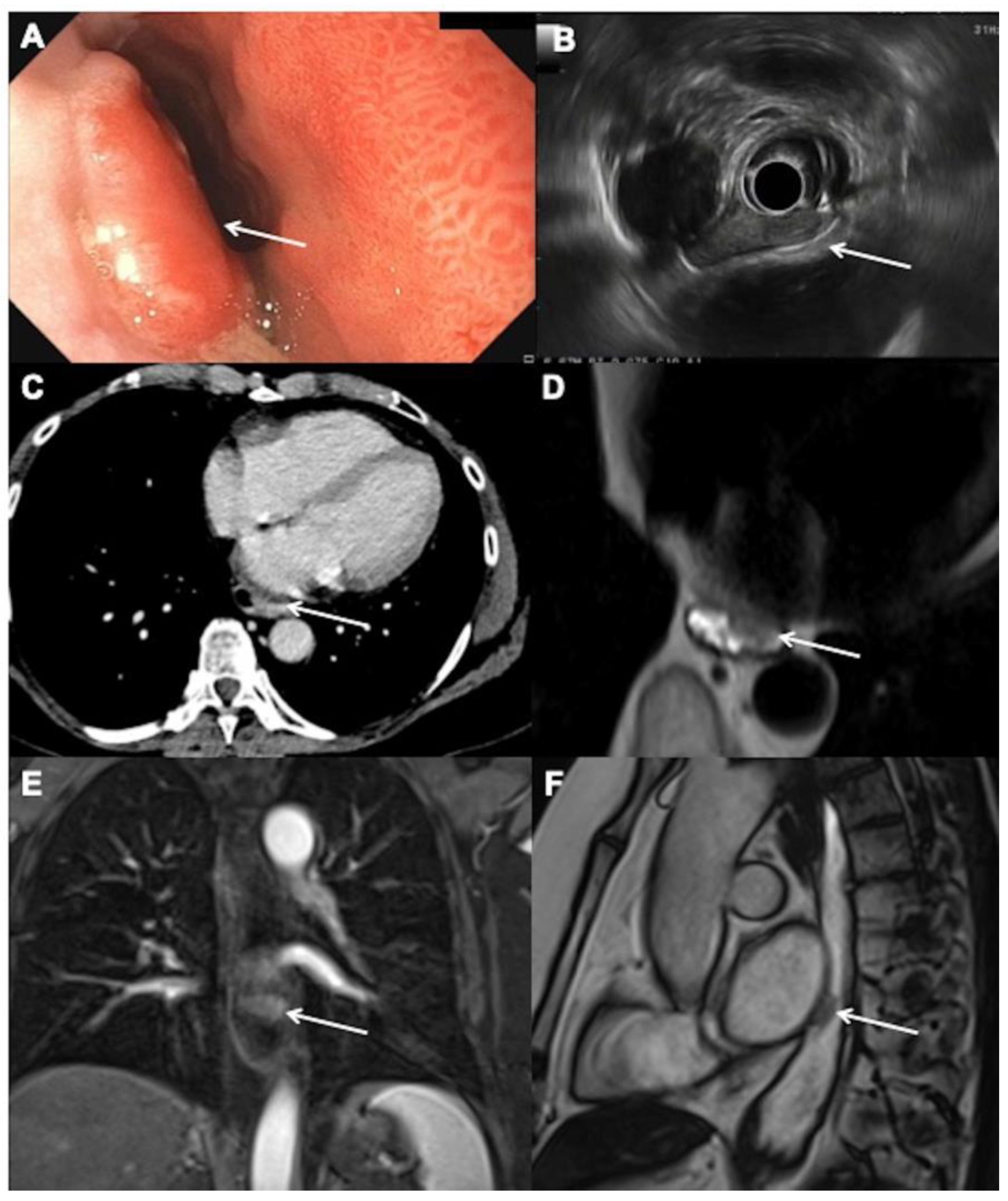 Cancers | Free Full-Text | The Role of Magnetic Resonance Imaging in the  Management of Esophageal Cancer