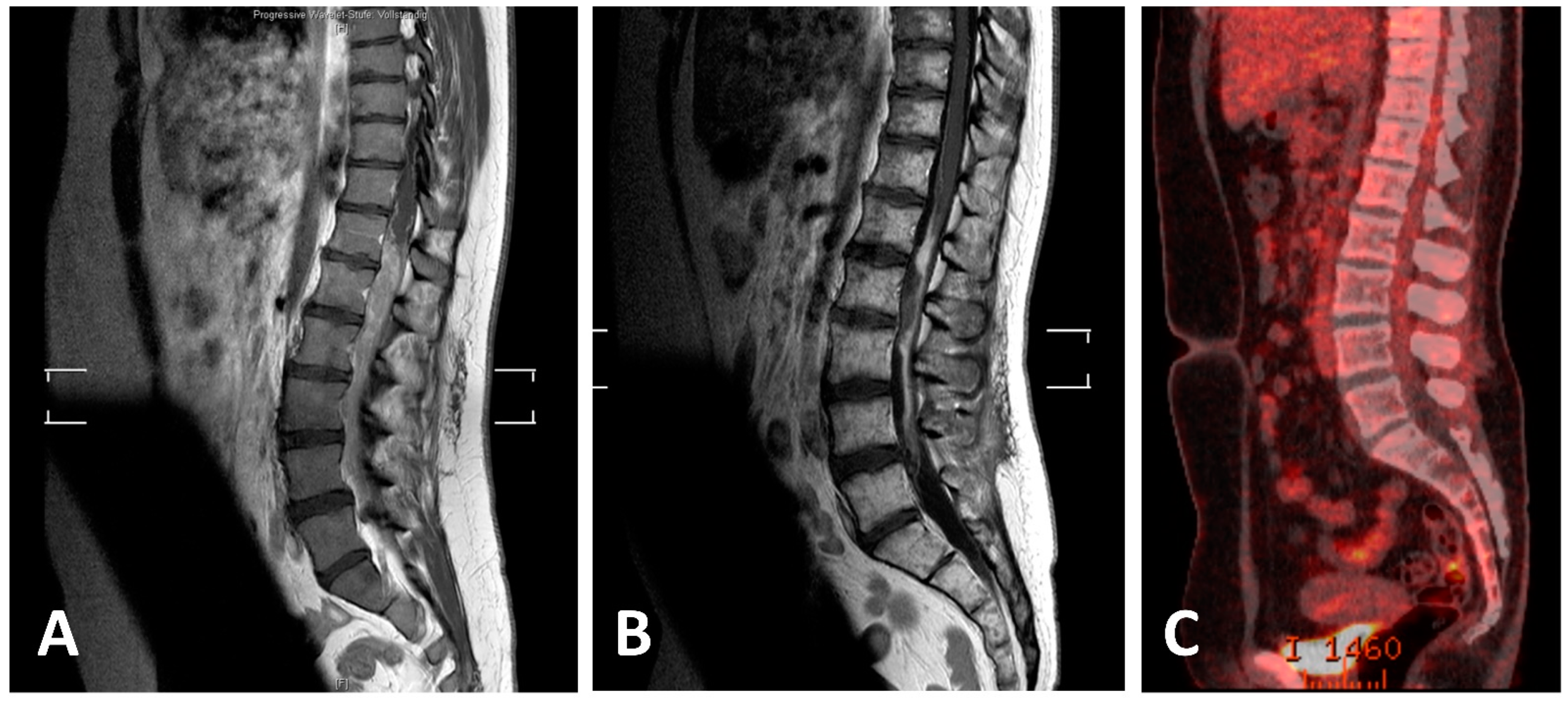 The Ewing's sarcoma of cervical spine—a rare occurrence