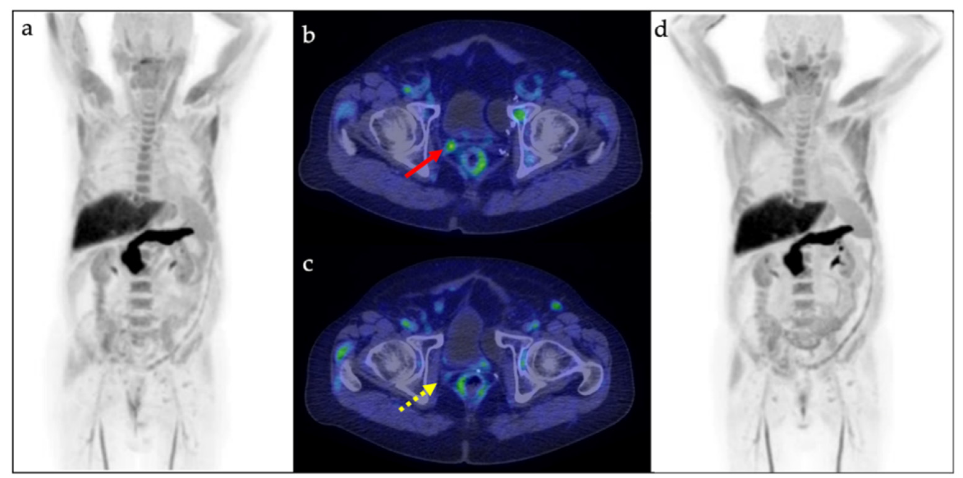 18F-fluciclovine-PET/CT imaging versus conventional imaging alone to guide  postprostatectomy salvage radiotherapy for prostate cancer (EMPIRE-1): a  single centre, open-label, phase 2/3 randomised controlled trial - The  Lancet