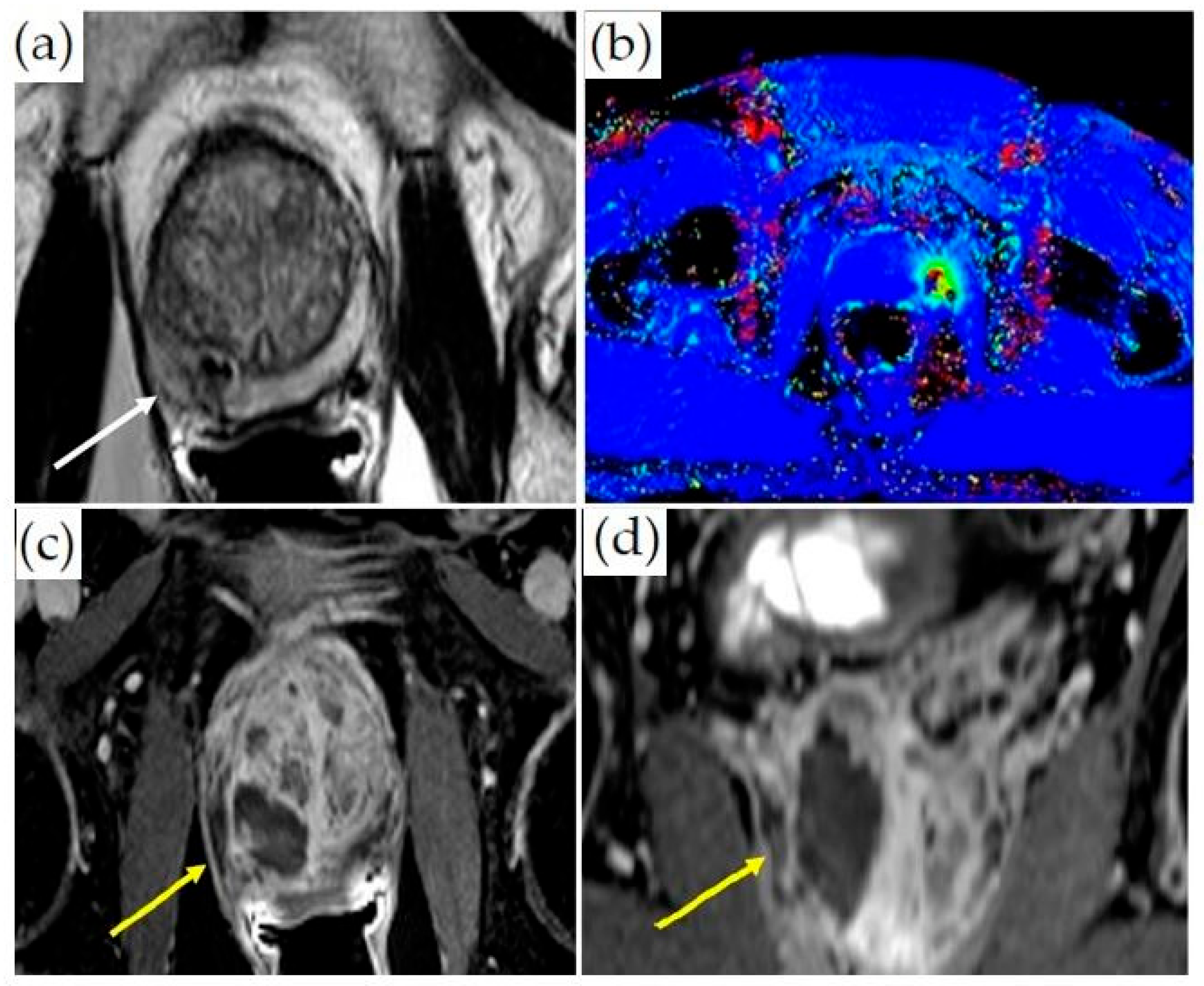 Cancers | Free Full-Text | Real-Time MRI-Guided Prostate Interventions