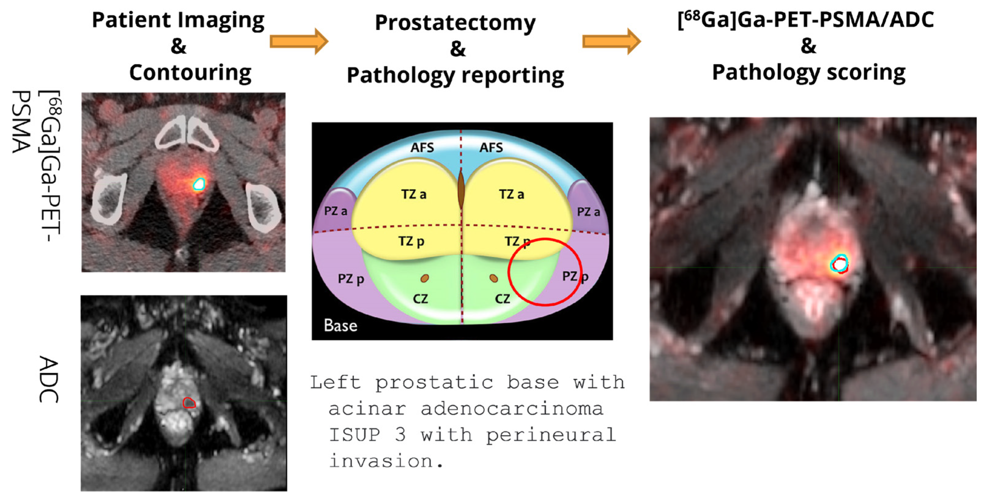 Cancers Free Full Text Radiomics Analysis On Ga Ga Psma Pet And Mri Adc For The