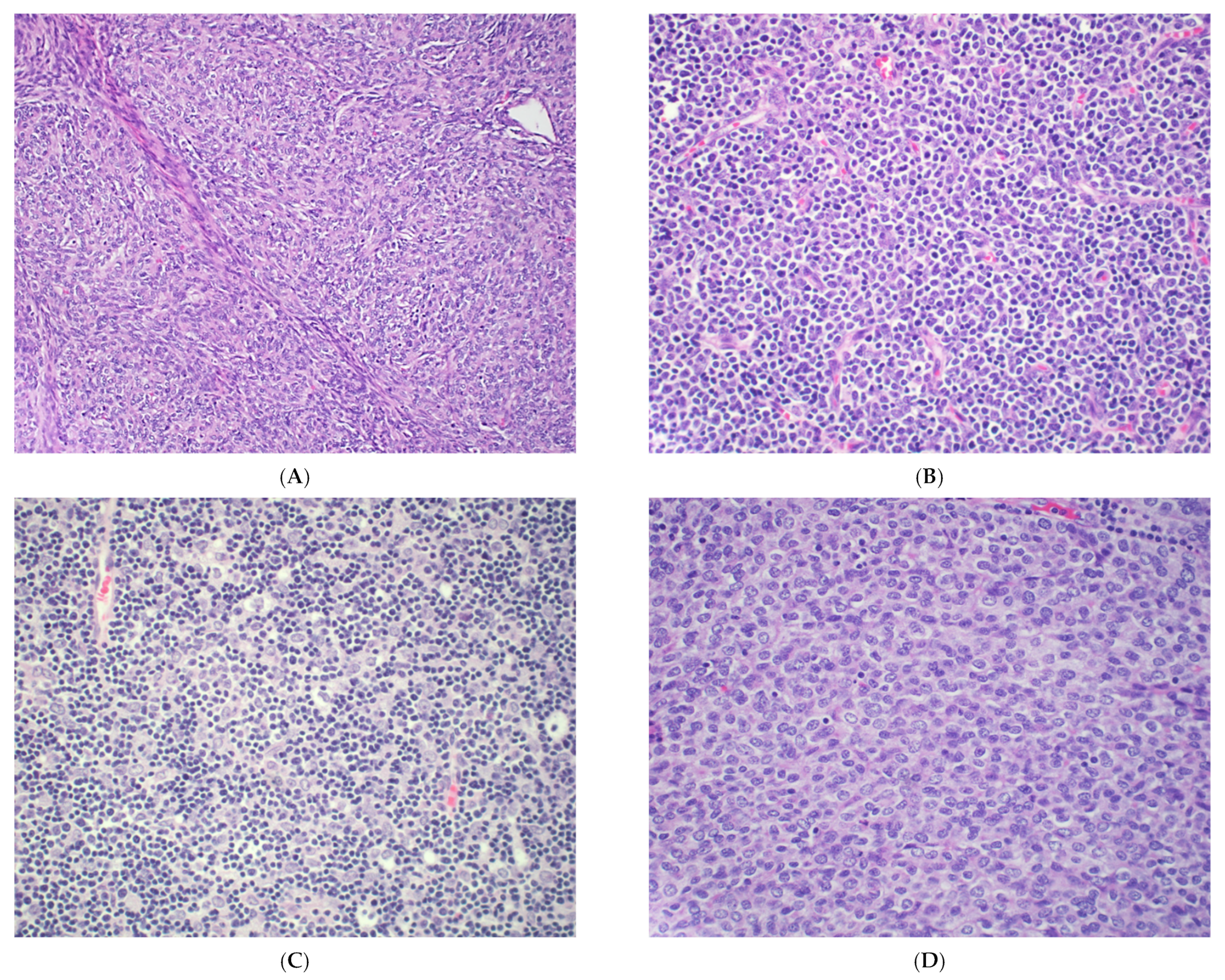 Cancers | Free Full-Text | Diagnostic Challenges in the Cytology of Thymic  Epithelial Neoplasms