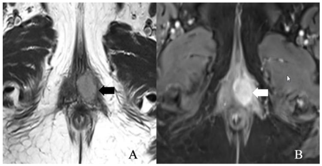 Cancers Free Full Text Vulvar Cancer 2021 Revised Figo Staging System And The Role Of Imaging 