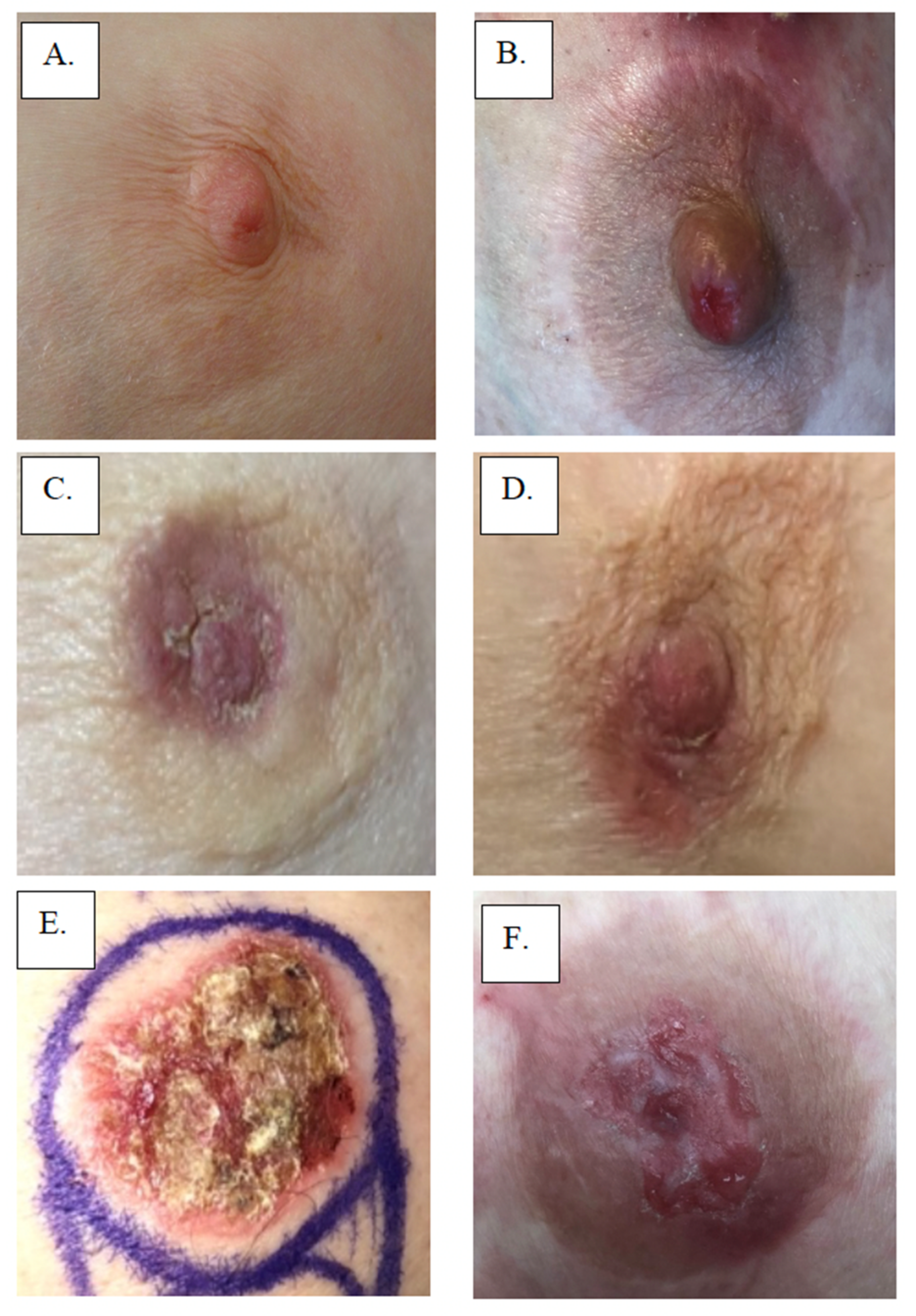 A -Preoperative examination showing evident breast size asymmetry; B