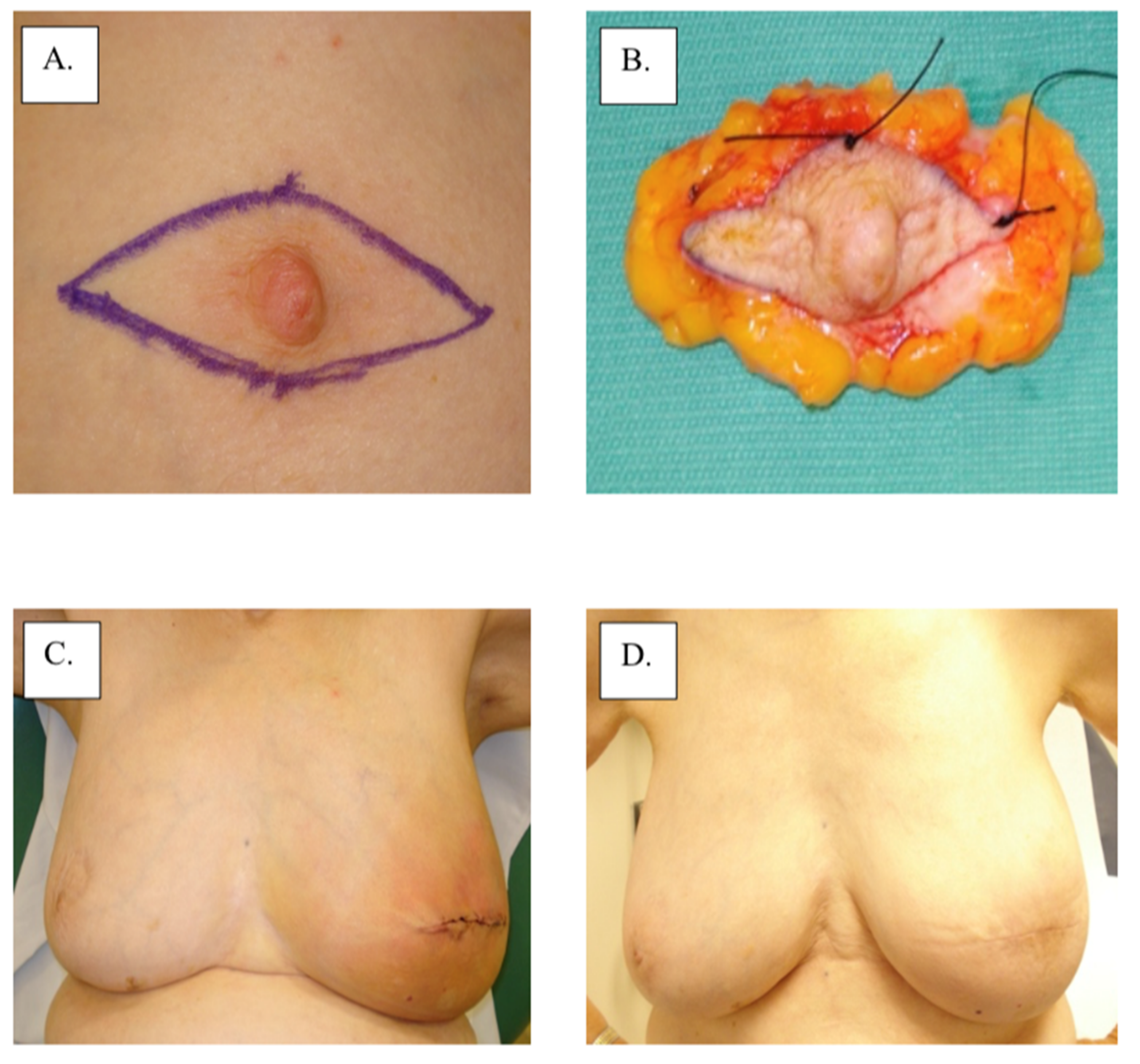 Paget's Disease of the Breast: Causes, Treatment, & More