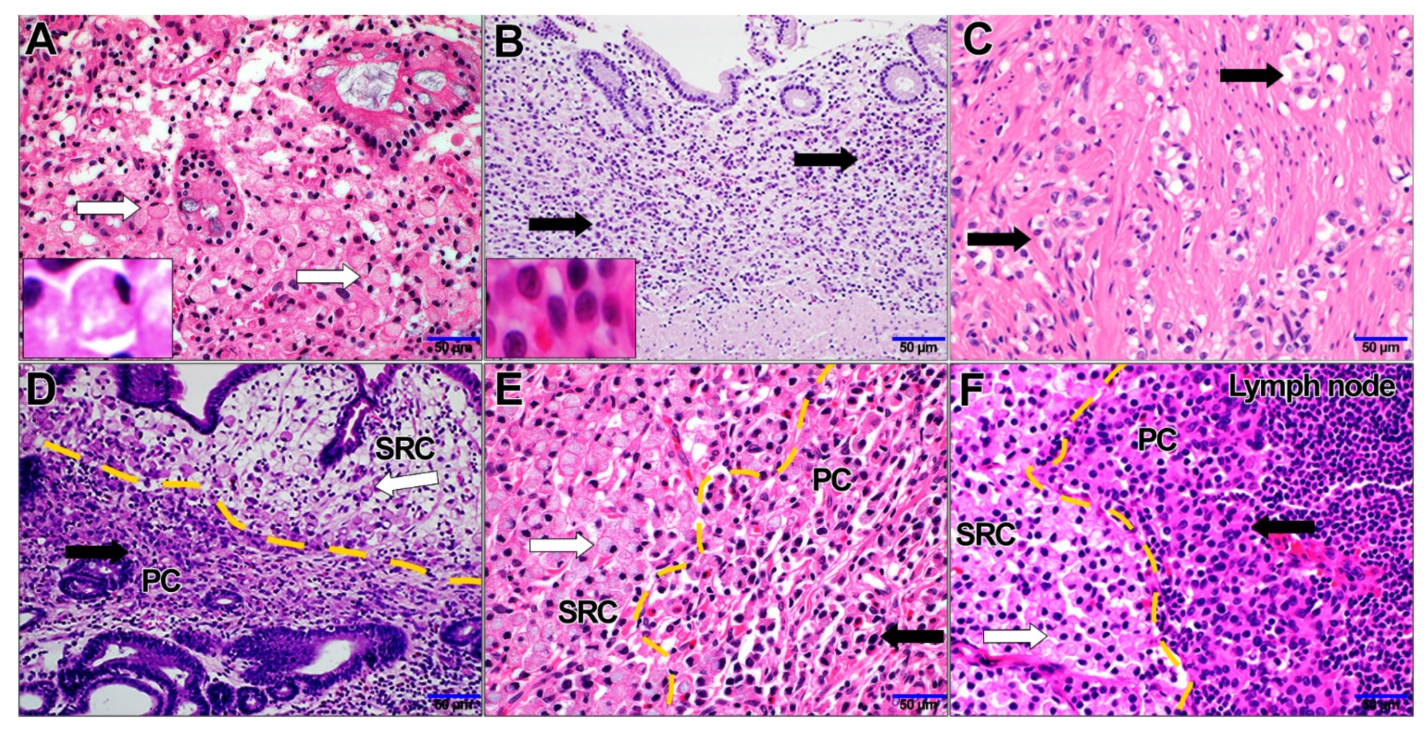 Cancers | Free Full-Text | Characterization of Poorly Cohesive and Signet Ring  Cell Carcinomas and Identification of PTPRM as a Diagnostic Marker