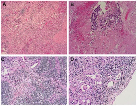 Cancers | Free Full-Text | Rescue Surgery after Immunotherapy/Tyrosine ...