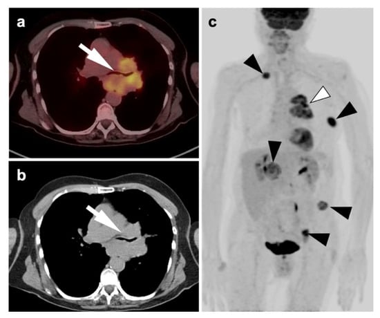 Cancers | Free Full-Text | PET-CT in Clinical Adult Oncology: II 