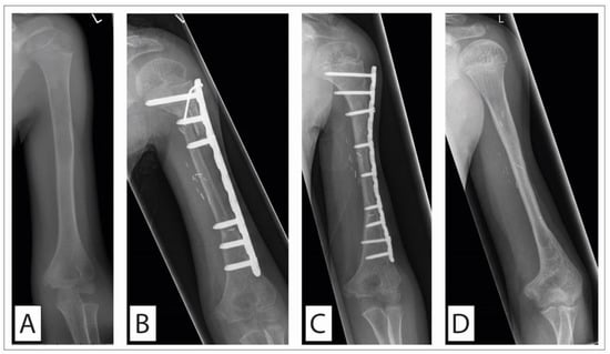 Cancers | Free Full-Text | Surgical Treatment of Bone Sarcoma