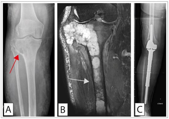 Cancers | Free Full-Text | Surgical Treatment of Bone Sarcoma