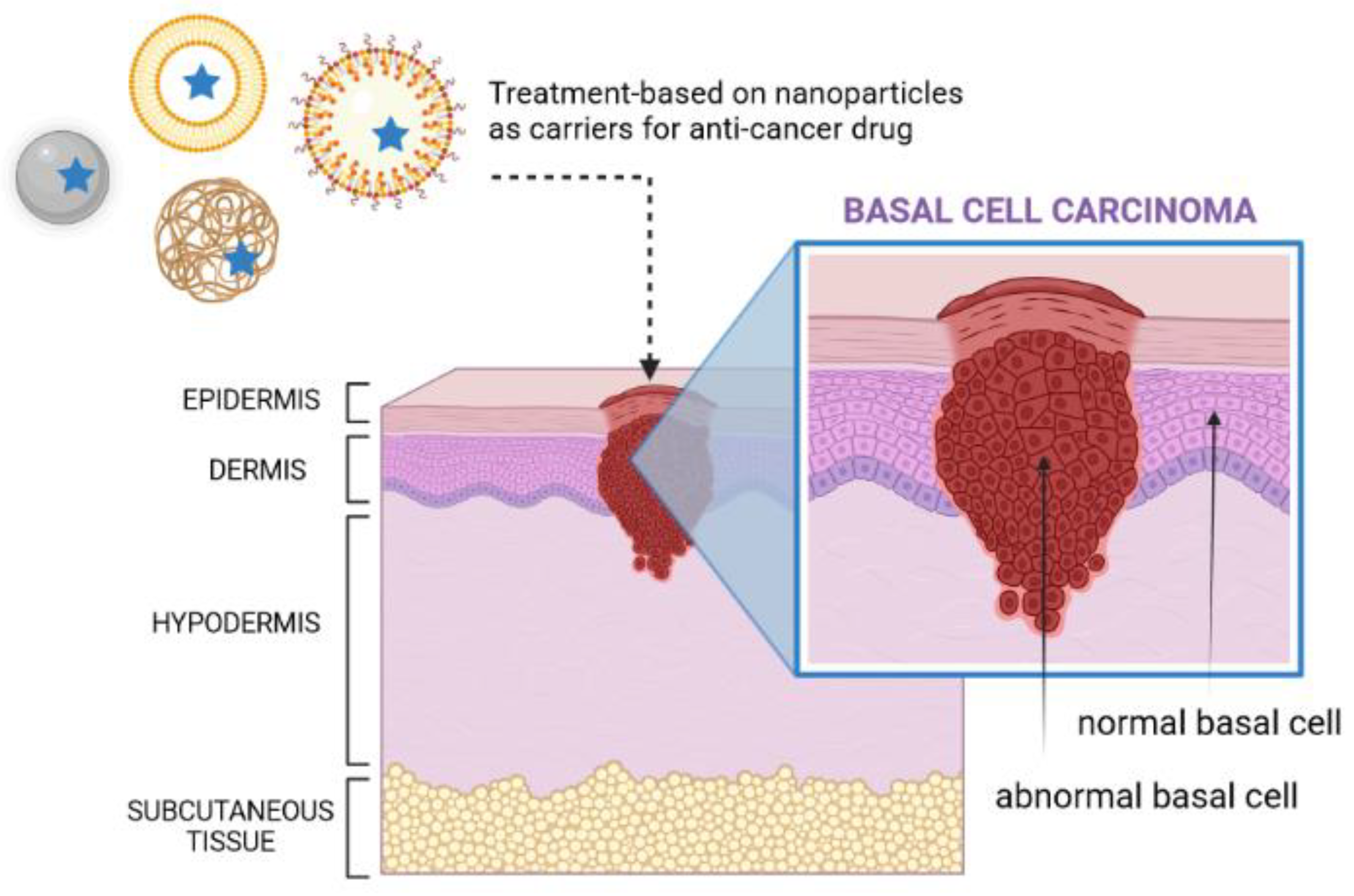 Cancers | Free Full-Text | Basal Cell Carcinoma: Pathology, Current ...