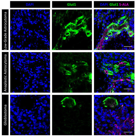 Cancers | Free Full-Text | 5-Aminolevulinic Acid (5-ALA)-Induced