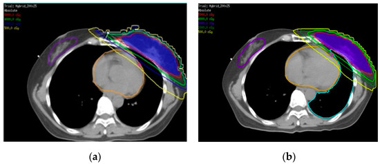 Typical dose distributions of a patients with a pendulous breast