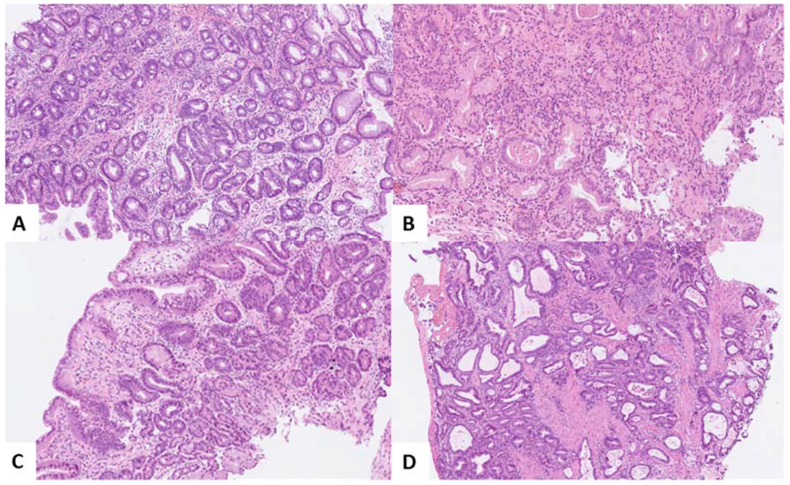 Cancers | Free Full-Text | Sex Differences in Neoplastic Progression in  Barrett’s Esophagus: A Multicenter Prospective Cohort Study