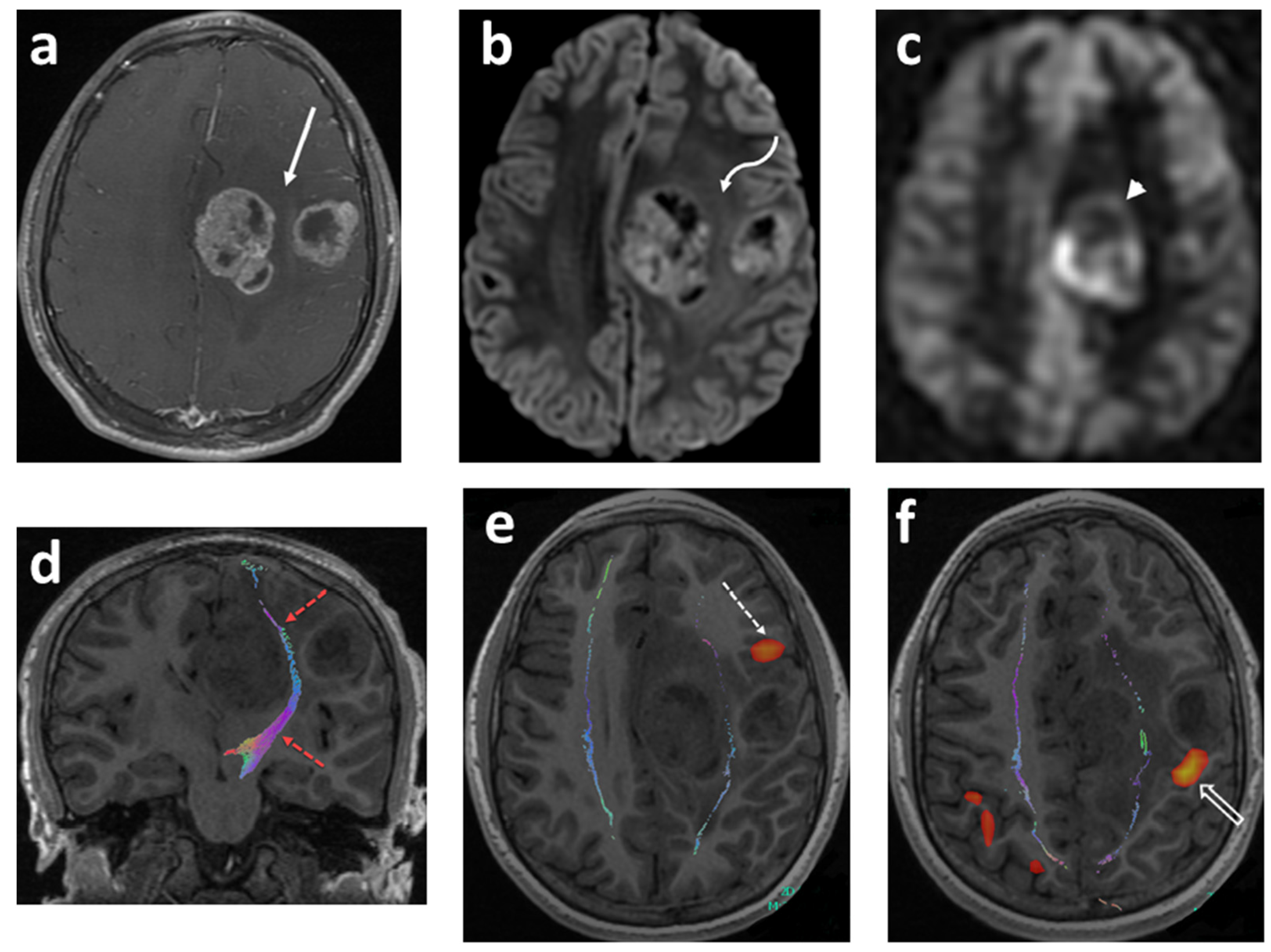 Cancers | Free Full-Text | Advanced Neuroimaging Approaches to